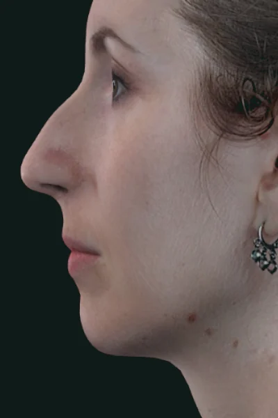 Captura tridimensional antes do planejamento — perfil